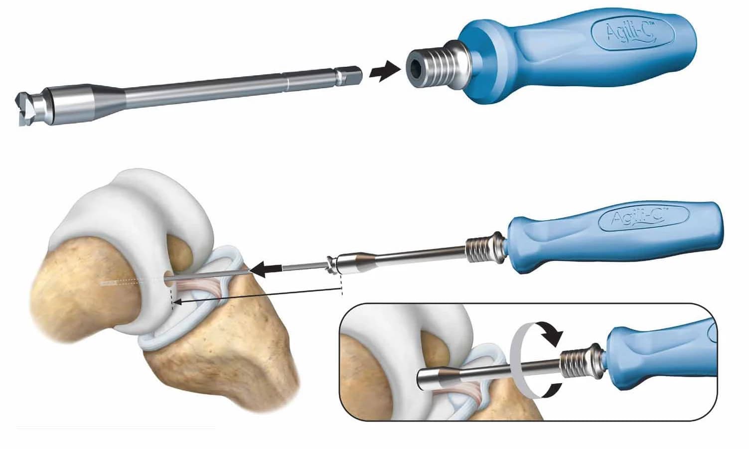 CartiHeal osteochondral site being drilled and shaped